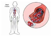How heart failure causes fluid accumulation