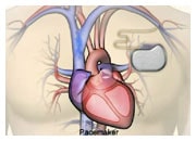 How medical devices work in heart failure